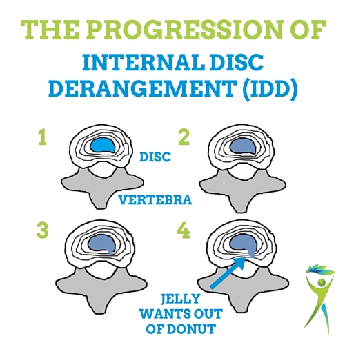 internal-disc-derangement