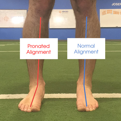 pronated-ankle-alignment