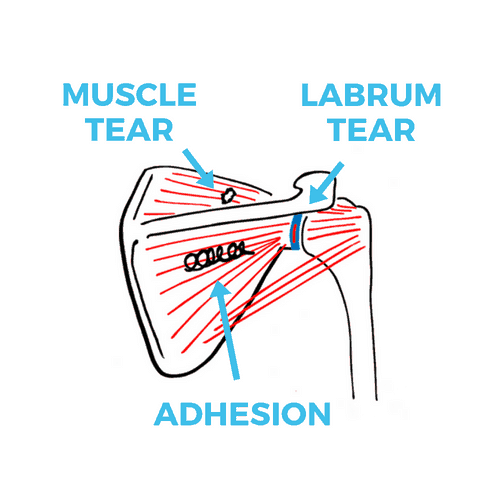 shoulder-pain-causes-3-problems
