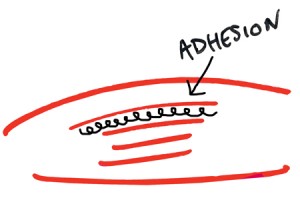 adhesion-between-muscles
