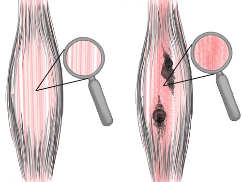 piriformis-syndrome-treatment-adhesion