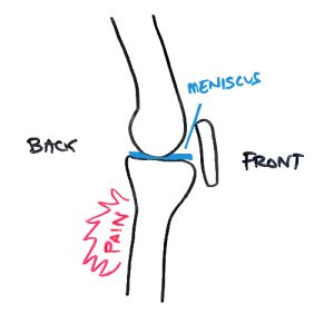 pain-behind-knee-meniscus