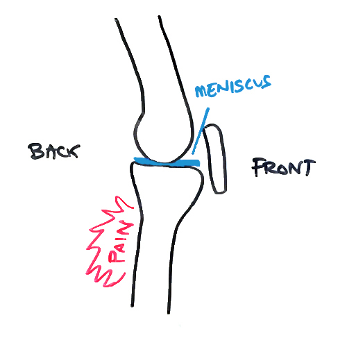 pain-behind-knee-meniscus