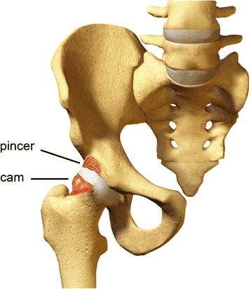 cam-pincer-malformation