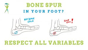 Bone-spur-in-the-foot