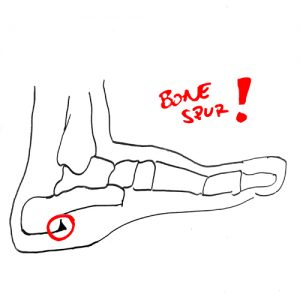 bone-spur-in-the-foot
