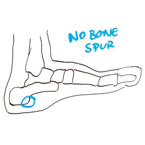no-bone-spur-in-the-foot