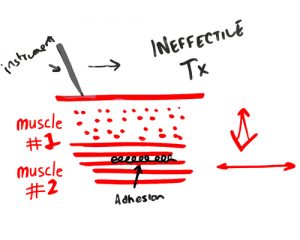 graston-technique-muscle-orientation-matters