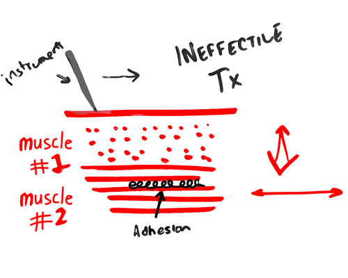 graston-technique-muscle-orientation-matters