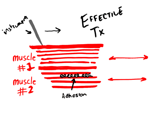 graston-technique-good-treatment