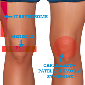 Knee-Injuries-From-Running-