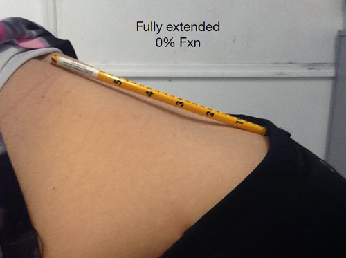 low-back-function-0-percent