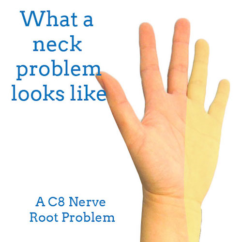 c8-nerve-problem