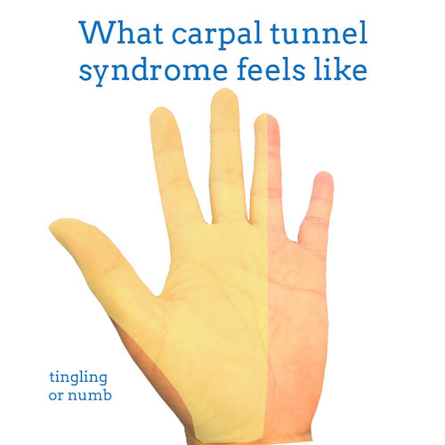 carpal-tunnel-syndrome-front-hand