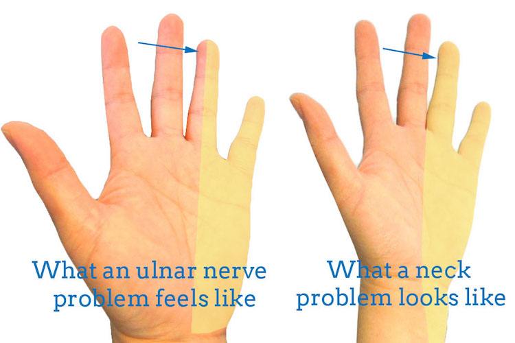 ulnar-nerve-vs-neck-problem
