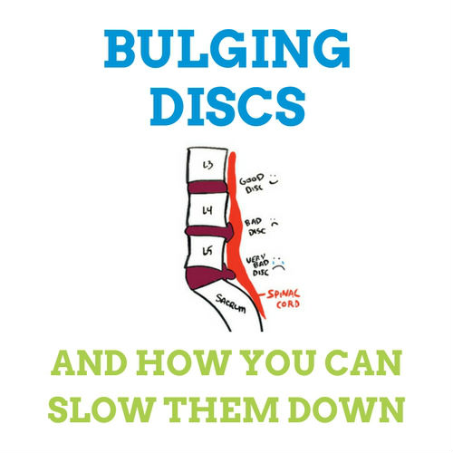 Bulging-Discs