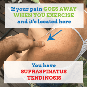 supraspinatus-tendinosis