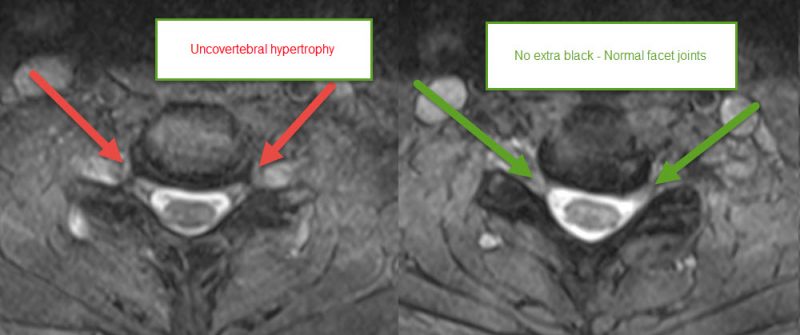 neck-strain-facet-joint-arthritis