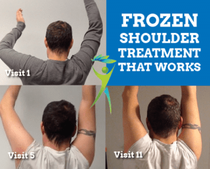 frozen-shoulder-treatment-that-works