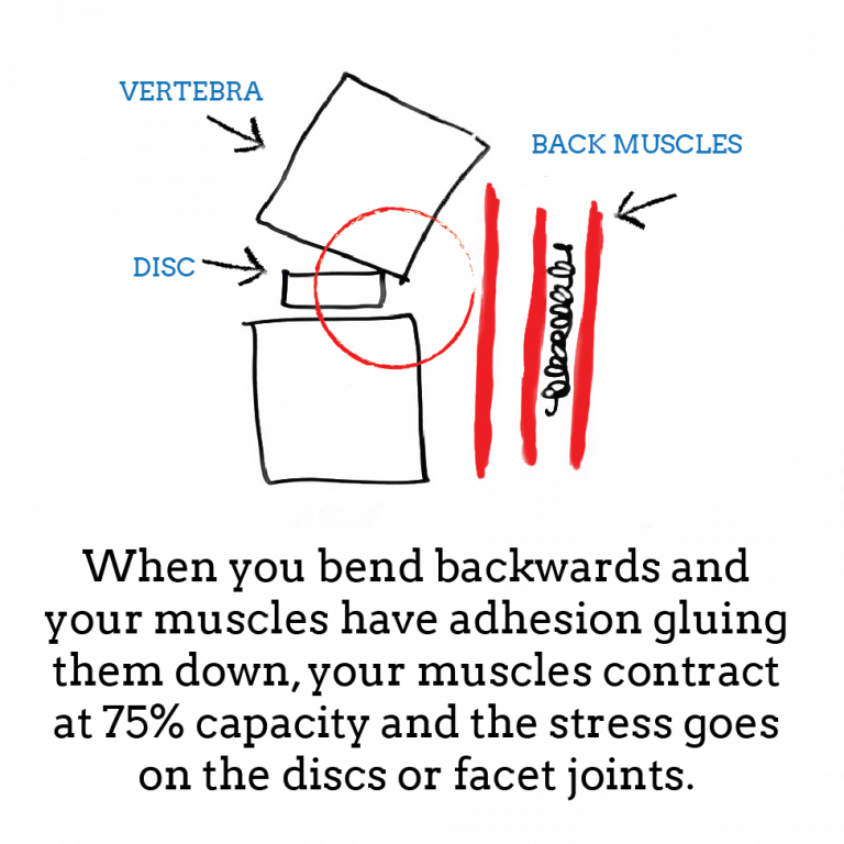 Back pain when bending backwards 2