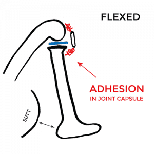 pain-on-inside-of-knee-Flexed-adhesion