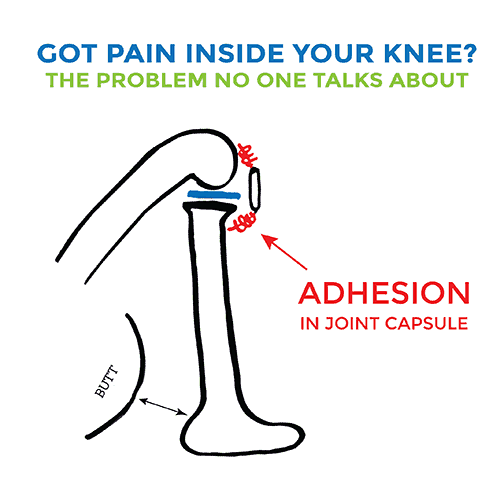 Pain On Inside Of Knee The Problem No One Is Talking About