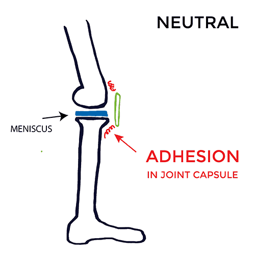 pain-on-inside-of-knee-Neutral-adhesion