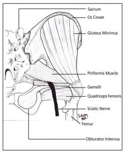 piriformis-syndrome-treatment