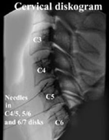 cervical-discography