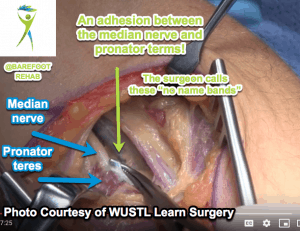 cortisone-shots-adhesion-median-nerve