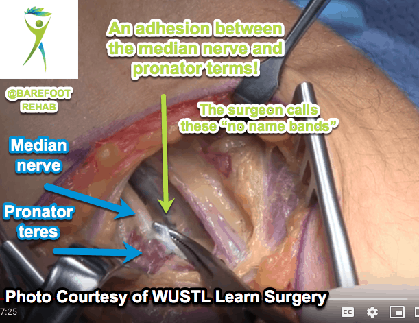 cortisone-shots-adhesion-median-nerve