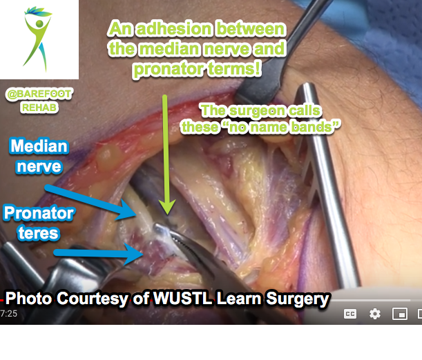 adhesion-median-nerve