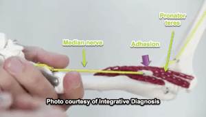 cortisone-shot-median-nerve-model