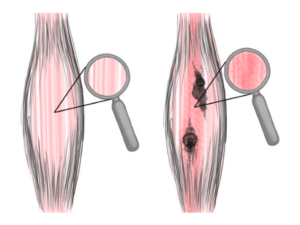 adhesion description for stress tension headaches