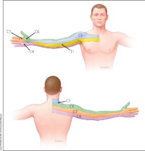 numb-hands-dermatomes