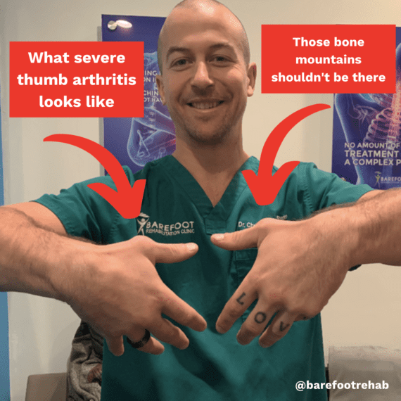 shockwavetherapythumbarthritis